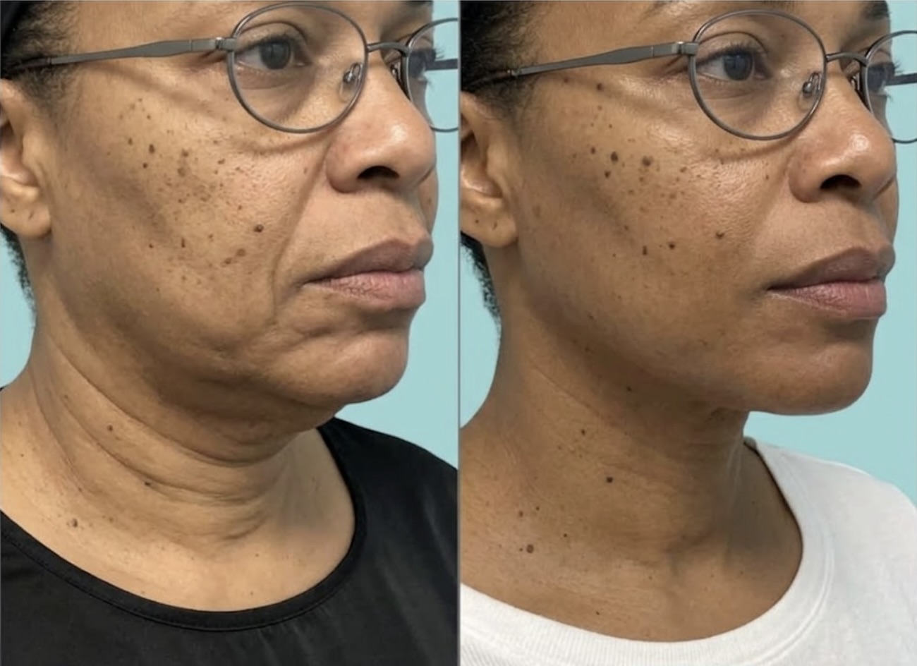 HIFU before and after result 3 for the lower face and neck